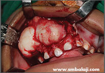 Tumor 4 Removal Of The Tumour From The Upper Jaw