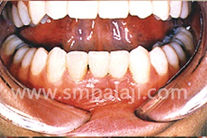 Distraction and Dental Implants 5 Replacement With Ceramic Crowns
