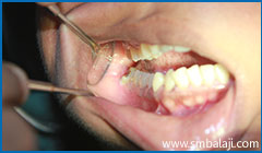 Transalveolar Extraction 4 Severely Decayed And Impacted Lower Right Wisdom Tooth