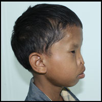Craniofacial Deformities 5 Before Surgery