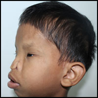Craniofacial Deformities 6 Before Surgery