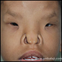 Craniofacial Deformities 7 Increased Distance Between The Eyes (50 Mm While Normal Is 35 Mm)