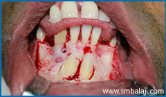 Transalveolar Extraction 2 Surgical Exposure Of Impacted Teeth