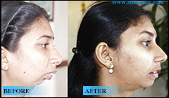 TM Joint Surgery 8 Tmj Jaw Joint Surgery