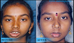 Tmj Surgery