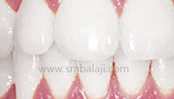 Teeth Whitening | Teeth Bleaching