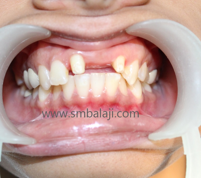 Teeth Adjoining Space Of Missing Upper Front Teeth Prepared