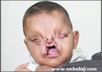 Tessier Cleft Deformity-Before Surgery