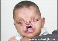 Face Reconstruction Surgery 1 Tessier Cleft Deformity-Before Surgery