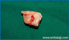 Tooth extractions or Exodontia 6 The Extracted Upper Right Third Molar