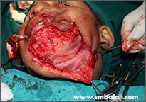 Trauma 5 The Newly Grown Excess Tissue Is Mobilized To Reconstruct The Burnt Portions Of The Face