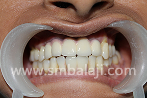 Prosthetic Rehabilitation Completed With Ceramic Crowns