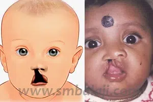 Unilateral (Right Side) Cleft Lip