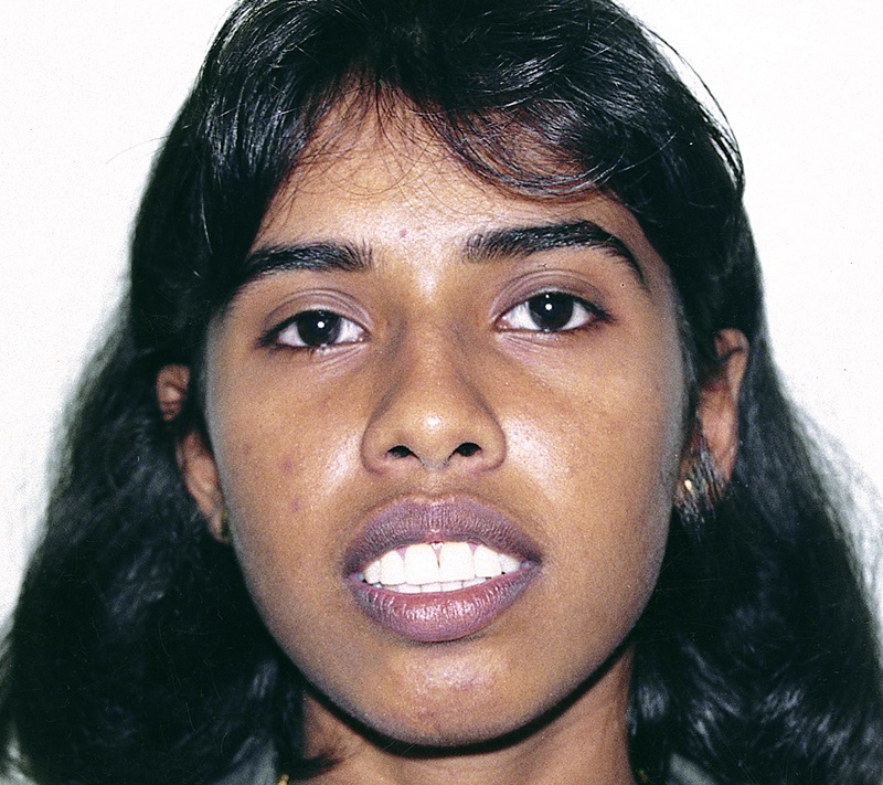 Before Surgery Jaw Surgeon In India