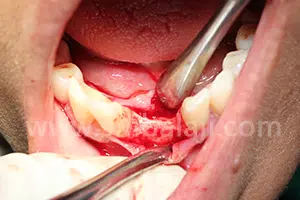 Very Thin Bone In Lower Jaw