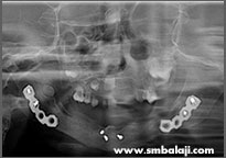 Tumor 10 X-Ray Before Implant Surgery, Showing Good Healing And Recovery