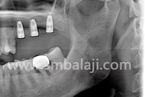 X-Ray Showing Dental Implants