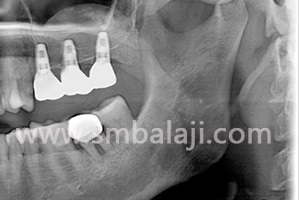 X-Ray Showing Increased Bone Height After Sinus Lift And Following Prosthesis Placement