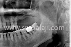 X-Ray Showing Region In Upper Jaw With Bone Insufficient To Place Implants