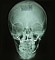 X Ray Showing Skeletal Asymmetry Of The Face Corrected After Treatment