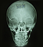Hemifacial Microsomia 17 X Ray Showing Skeletal Asymmetry Of The Face Corrected After Treatment