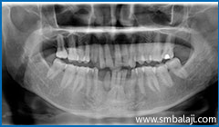 Transalveolar Extraction 1 X-Ray Showing Two Impacted Lower Canine Teeth