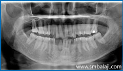 X-Ray Showing Two Impacted Lower Canine Teeth