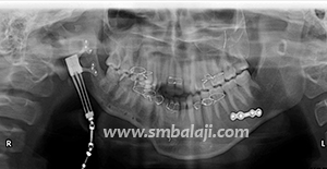 X Ray Taken After Surgery