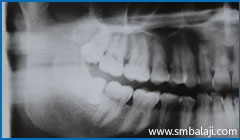 Tooth extractions or Exodontia 2 X-Ray Taken Before Extraction Of Upper Right Third Molar Tooth