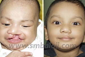 Before And After Cleft Lip Surgery