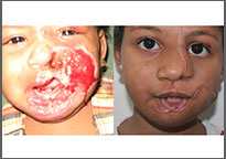 Trauma 1 The Child Suffered Severe Burns Of The Left Side Of Her Face; The Child After Reconstructive Surgery
