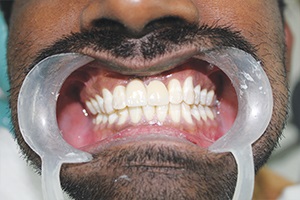 Dental Implant Chennai India