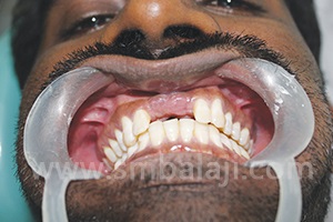 Dental Implant Chennai