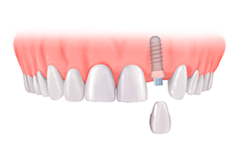 Dental Implant Chennai