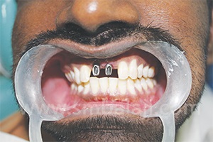 Dental Implant India