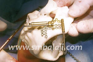Distraction Osteogenesis 1 Distractor