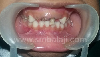Pediatric Dentistry 1 Early Childhood Caries