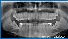 Transalveolar Extraction 6 X-Ray Showing 6 Impacted Teeth- Upper Right And Left Third Molars And Lower Right And Left Third And Second Molars