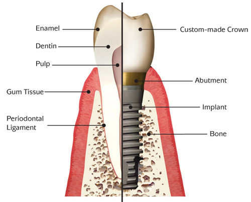 Implant Anatomy Basic Pic