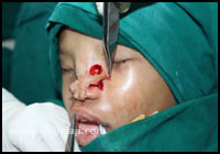 Craniofacial Deformities 15 Deficiency Of The Nose Is Corrected By Mobilizing The Tissues