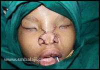 Craniofacial Deformities 16 Deficiency Of The Nose Is Corrected By Mobilizing The Tissues