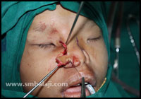 Craniofacial Deformities 14 Deficiency Of The Nose Is Corrected By Mobilizing The Tissues