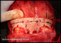 Craniofacial Deformities 11 Marking The Bone Cuts, To Remove Excess Bone