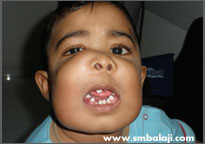 Tumor 2 Child At 18 Months Of Age With Tumour In Upper And Lower Jaw
