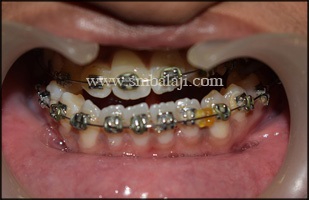 Intraoral View Showing Anterior Cross Bite Due To Forwardly Placed Lower Jaw