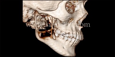 Preoperative 3DCT scan showing huge radiolucent lesion involving the entire ramus and angle of the mandible (right side)