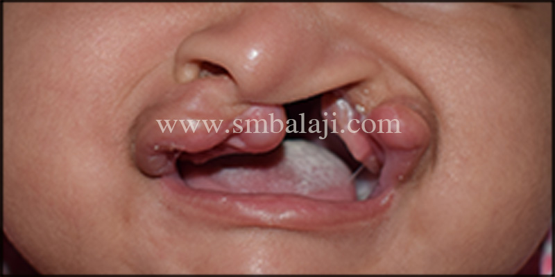 Unilateral cleft lip and palate defect in 3 months old baby boy Unilateral cleft lip and palate defect in 3 months old baby boy