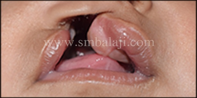 Unilateral cleft lip and palate defect in 3 months old baby girl