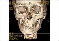 TMJ Growth Defects 1 Ct Scan Image Showing Asymmetry Of The Facial Skeleton