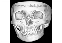 TMJ Growth Defects 5 Ct Scan Image Showing Facial Asymmetry Of The Facial Skeleton